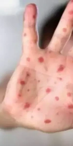 Kırmızı Alarm! Çocukları Vuran El, Ayak, Ağız Hastalığı Yayılıyor! Uzmanlardan Kritik Uyarılar! 📢
